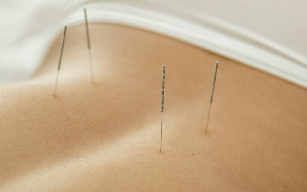 Acupuncture Needles For Sleep